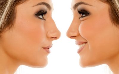 A nose job without the surgery? YES! It’s possible!