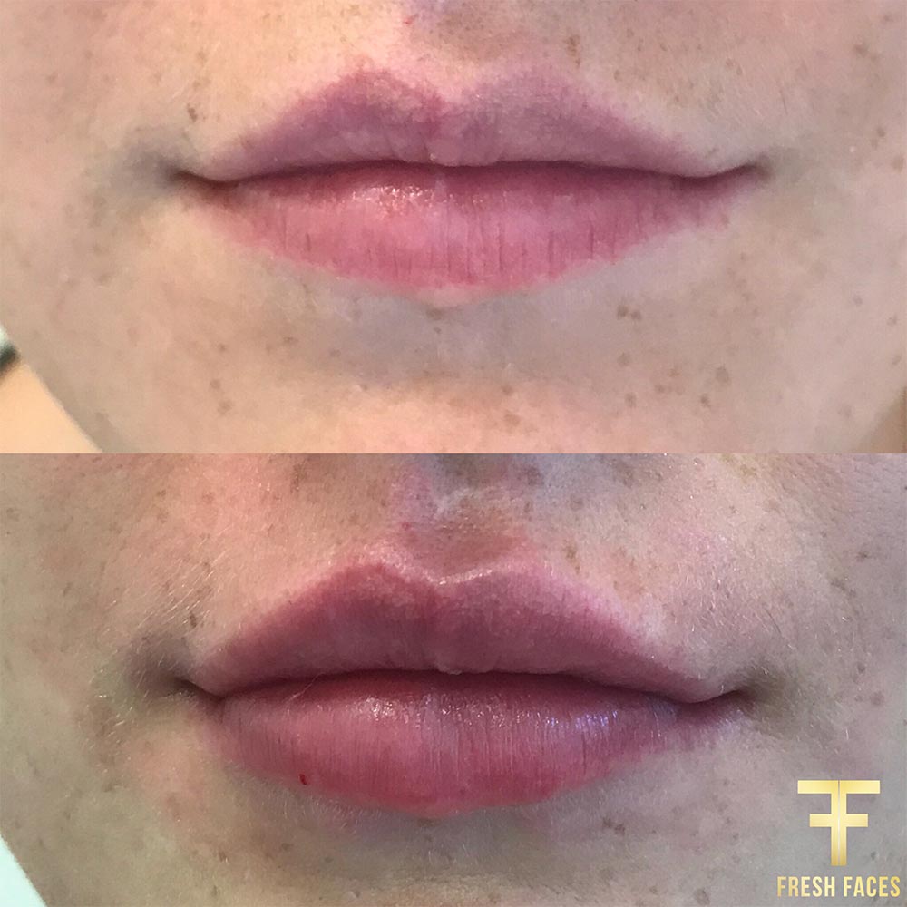 Lip injections before and after photos at Fresh Faces Perth, the best choice for fuller lips, Natural fillers. Book your consultation today.