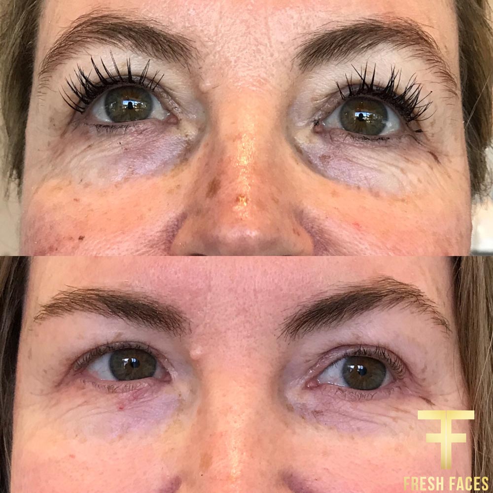 Natural Under Eye Fillers before and after. Fresh Faces Cosmetic Medicine Perth