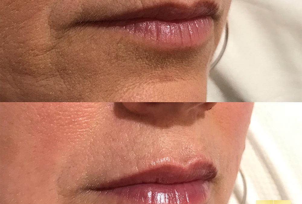 Best Lip Injections Perth. Fresh Faces Cosmetic Medicine