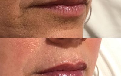 Best Lip Injections Perth. Fresh Faces Cosmetic Medicine