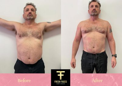 Body Sculpting Perth Before and After 2