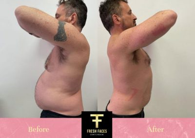 Body sculpting Perth before and after