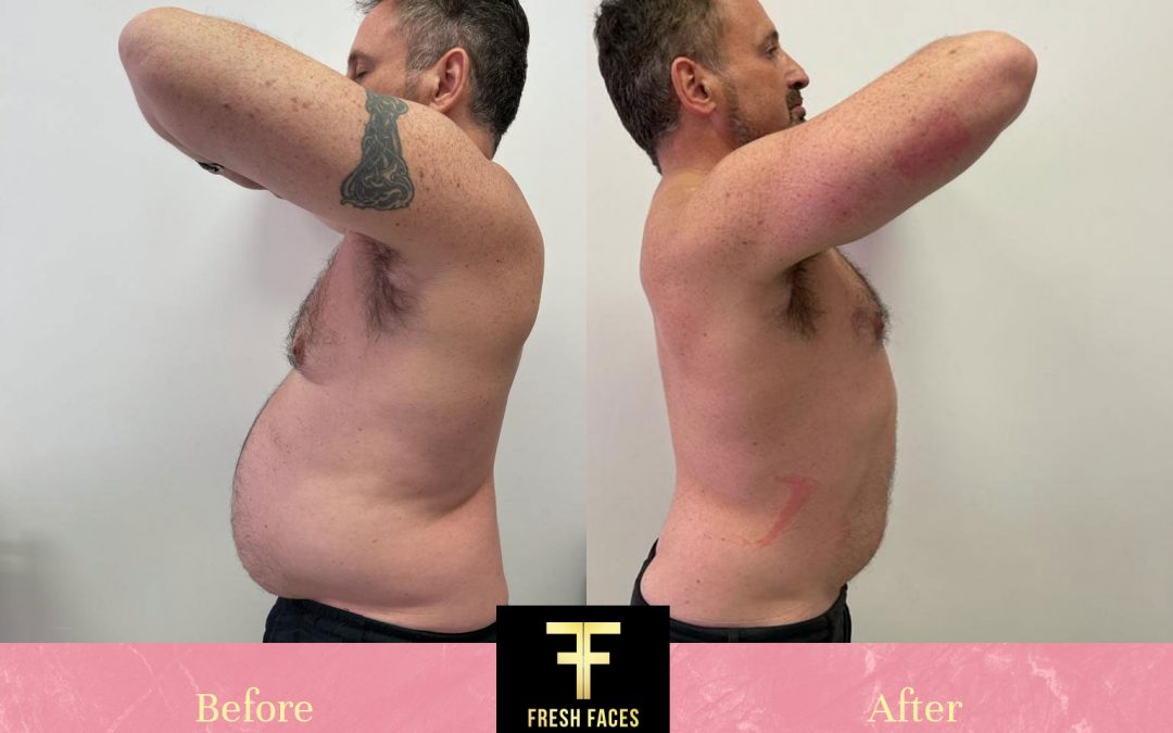 Body Contouring Before & After – TruSculpt treatments with our own Dr Ilan Josephs!
