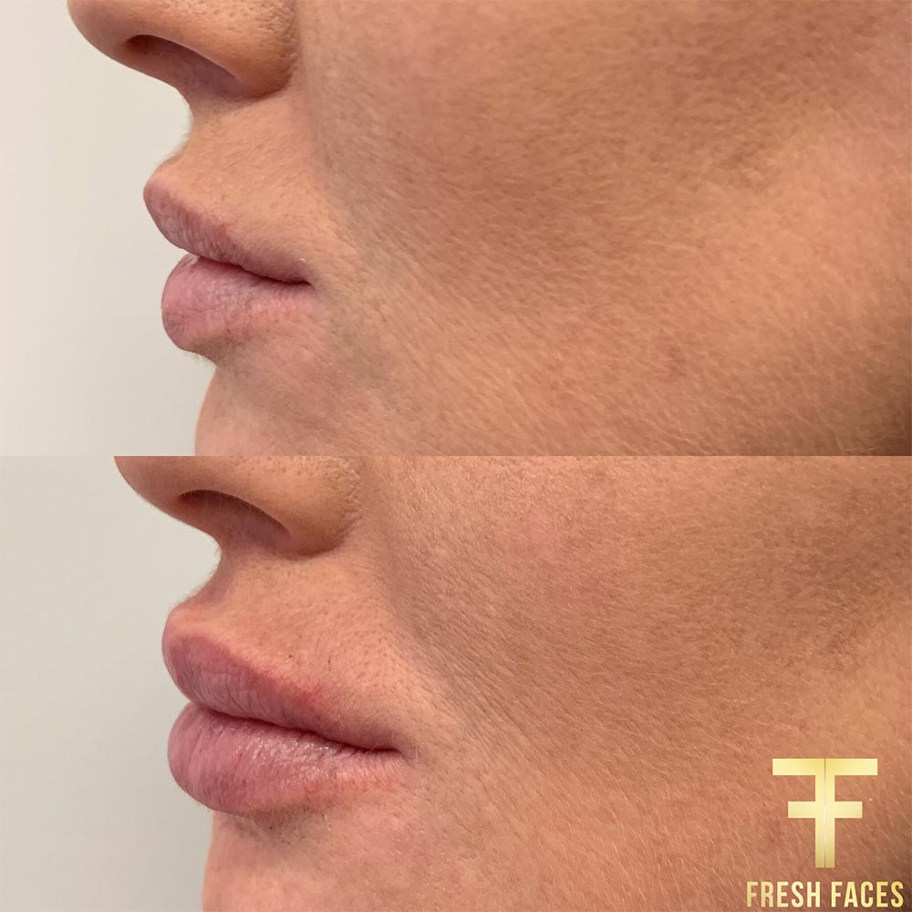 Lip filler before and after photos, Fresh Faces Perth for the best natural lip fillers. Book a free consultation